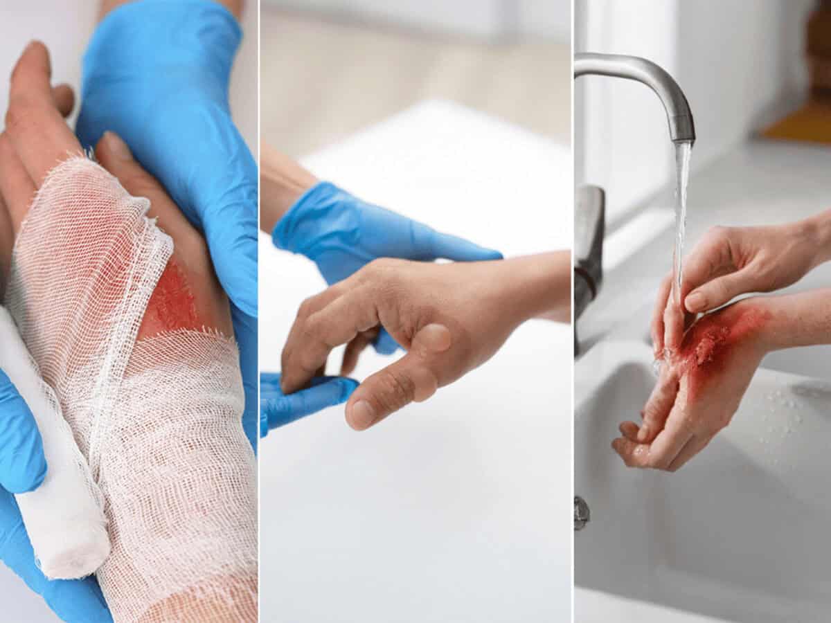 熱傷治療マニュアル = CURRENT TREATMENT FOR BURN … How to Treat a Burn? Types and Treatment