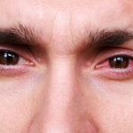 arc eye