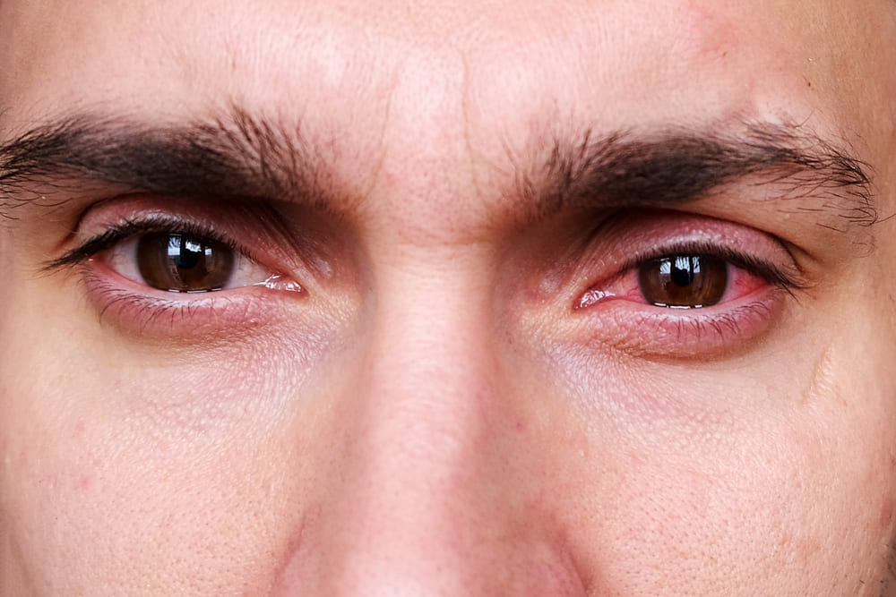 arc eye