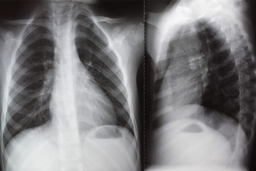 Asbestosis Symptoms - Health Concerns after Asbestos Exposure