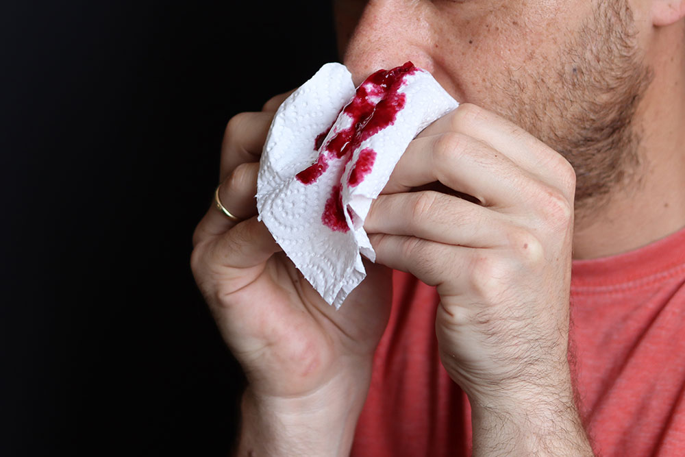 first aid for bleeding nose