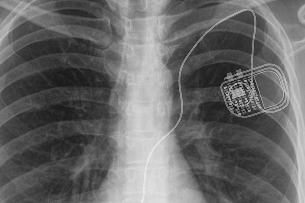 implantable cardioverter defibrillators (ICDs)