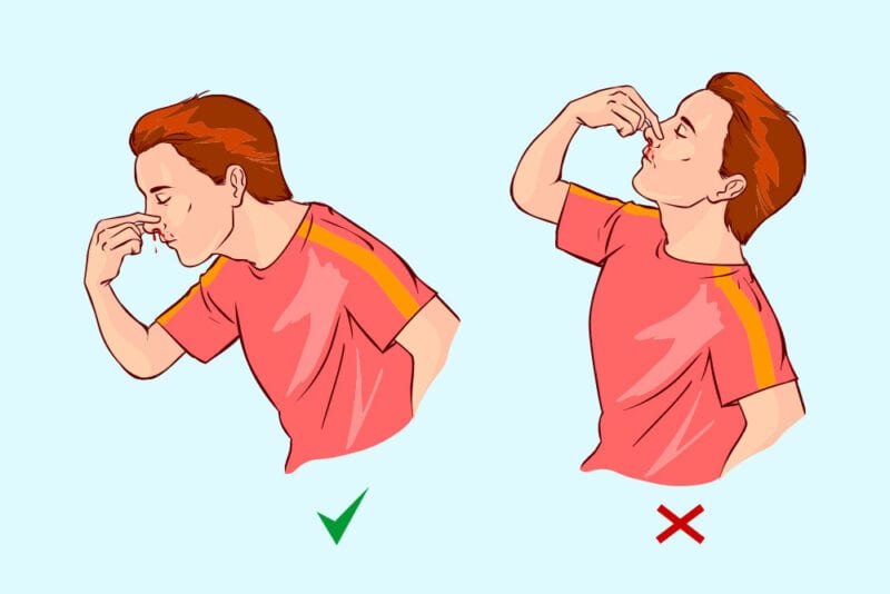 Can Stress Cause Nosebleeds?